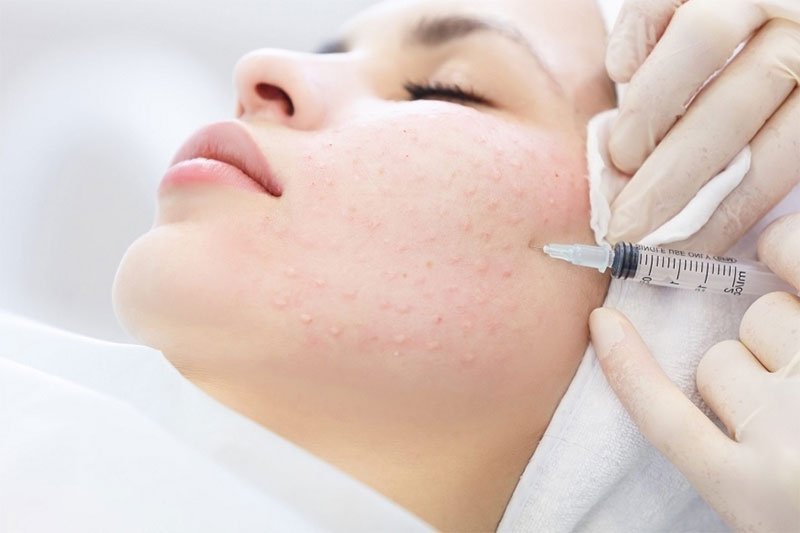 AKN ACNE - Tiêm meso trị mụn và kiểm soát bã nhờn