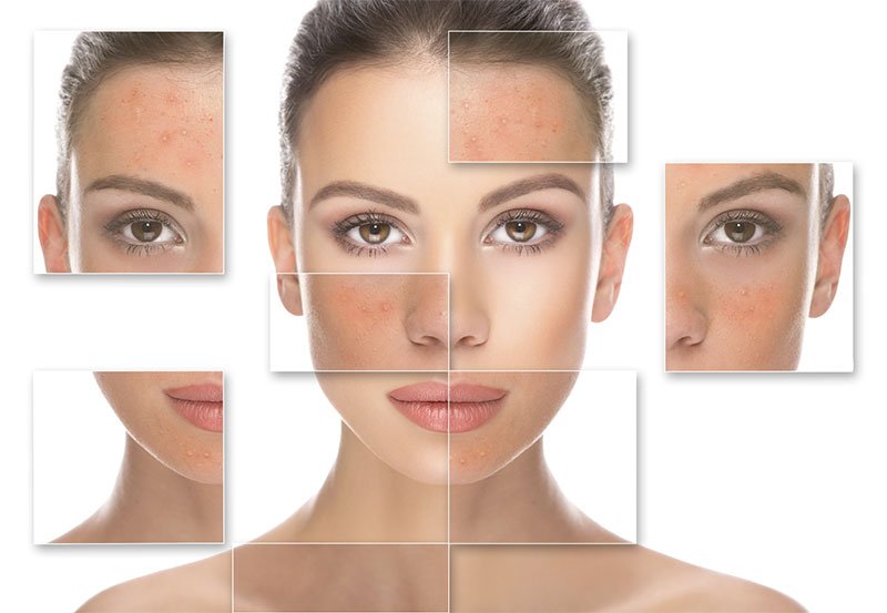 ACNE PEELS: Kiểm soát nhân mụn và quản lý sừng hóa trên da