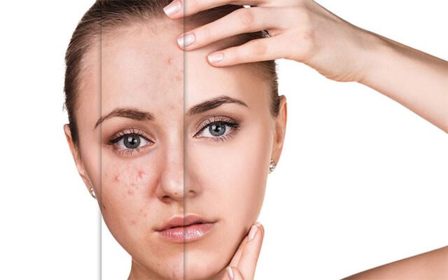 Anti Acne - Trị mụn hiệu quả cho mọi cấp độ