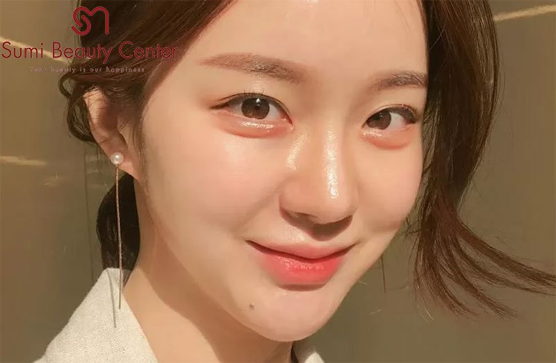 Bọng mắt là gì? Nguyên nhân và cách chữa bọng mắt dưới hiệu quả