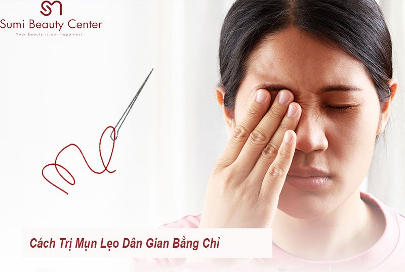 Cách Trị Mụn Lẹo Dân Gian Bằng Chỉ – Bí Quyết Lành Từ Xưa