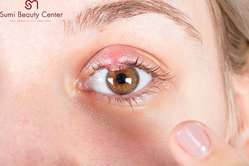Mụn Lẹo Là Gì? Nguyên Nhân và Cách Điều Trị Hiệu Quả Nhất