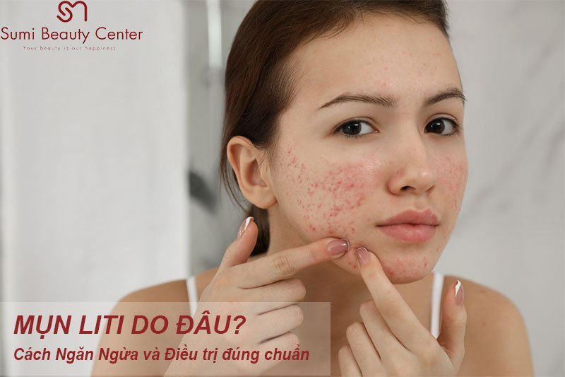 Mụn li ti ở mặt do đâu? Cách điều trị chuẩn y khoa ra sao?