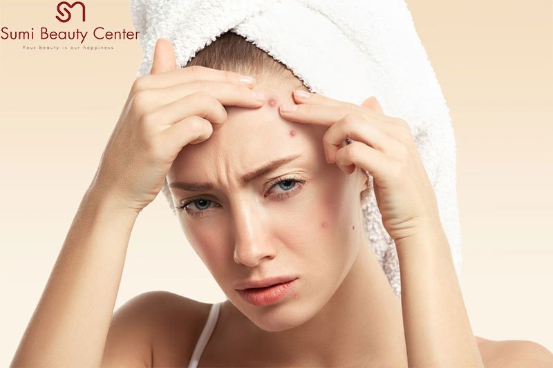 Cách đẩy cồi mụn tự nhiên tại nhà Cách đẩy cồi mụn tự nhiên tại nhà