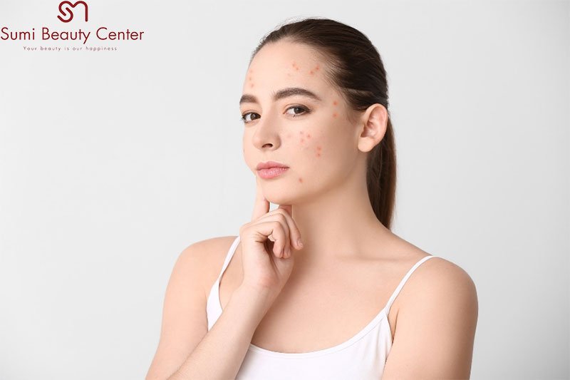 Những thắc mắc khi nổi mụn đỏ ở má? Những thắc mắc khi nổi mụn đỏ ở má?