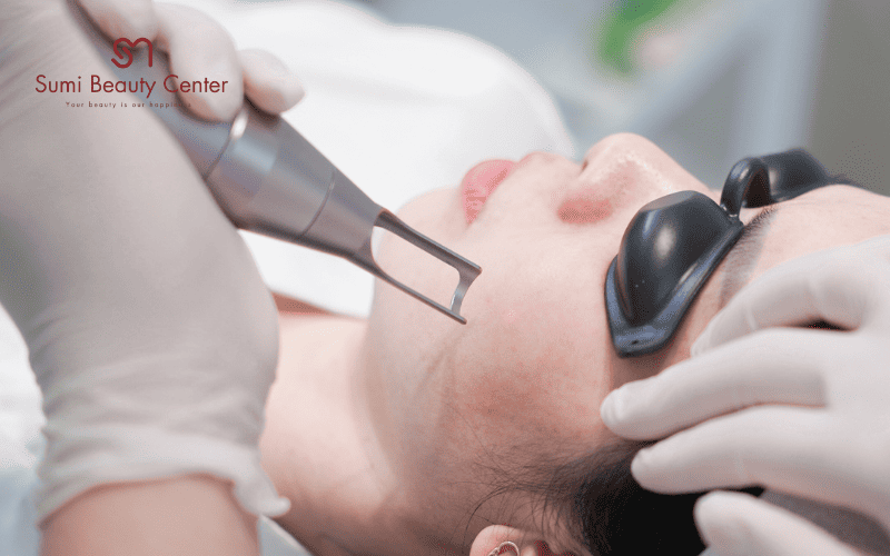 giải pháp điều trị tàn nhang bằng công nghệ Laser thế hệ mới