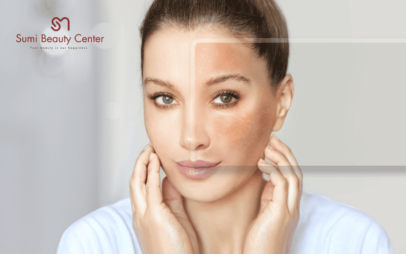 Kết quả sau điều trị bằng Laser