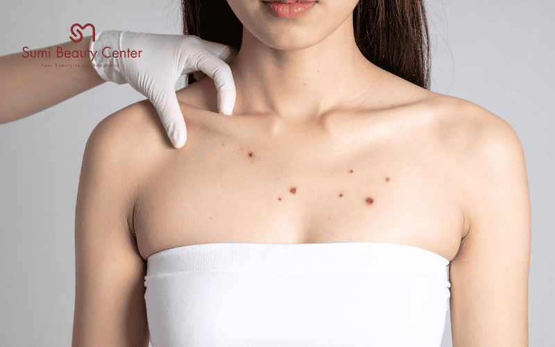 Nốt ruồi là gì?