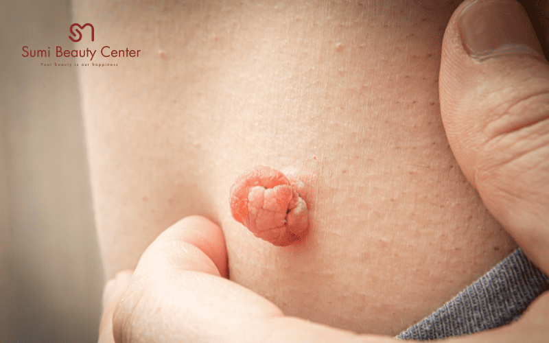 Ưu điểm của Laser trị mụn thịt