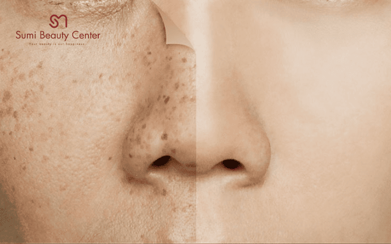 Kết quả sau khi điều trị bằng Laser