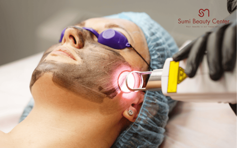Quy trình trẻ hóa bằng Laser Toning tại Sumi Beauty Center
