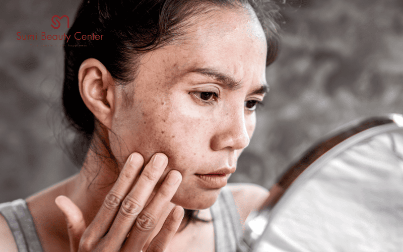 Quy trình trị nám bằng Laser tại Sumi Beauty Center