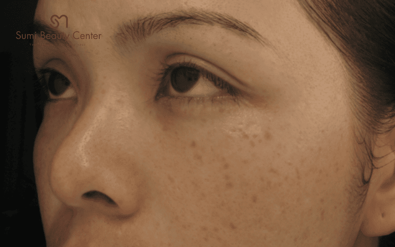 Quy trình trị tàn nhang bằng Laser