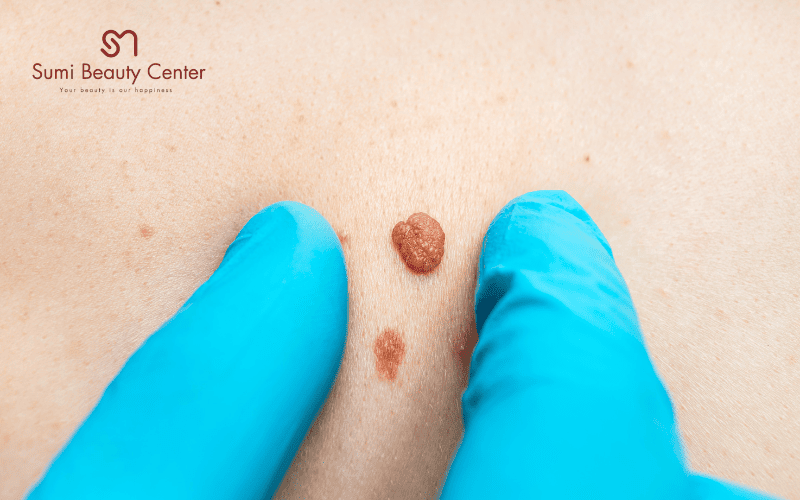 Mụn thịt là gì?