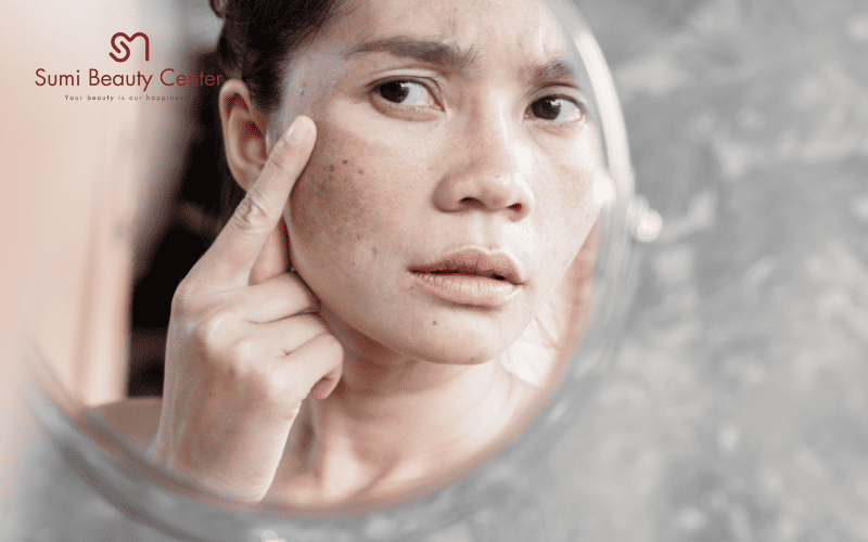 Ưu điểm của Laser trị nám tại Sumi Beauty Center