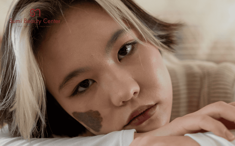 Quy trình điều trị Laser trị bớt