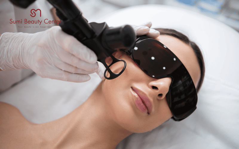 Phương pháp Laser trị tàn nhang là gì?