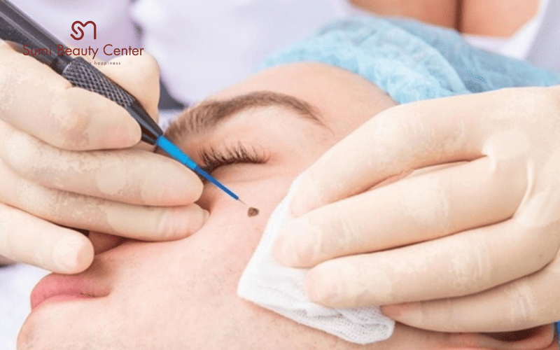 Phương pháp Laser trị nốt ruồi