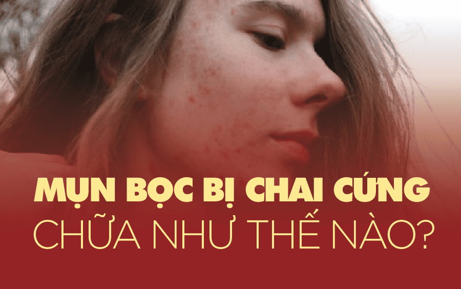 Cách nặn mụn bọc bị chai cứng