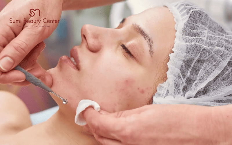 Cách xử lí mụn bọc để nhanh xẹp tại nhà