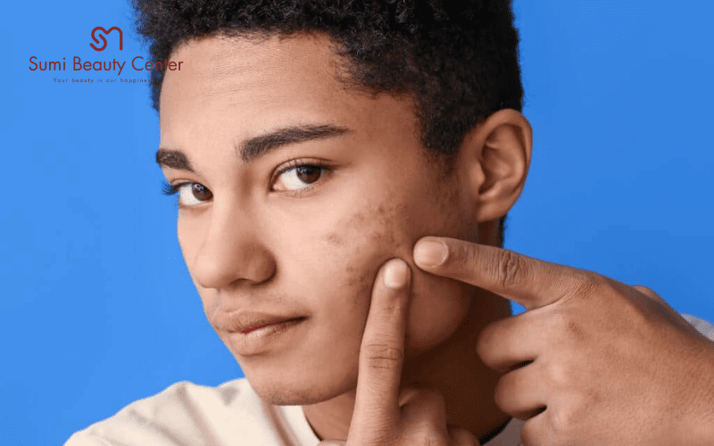 Có nên nặn mụn tuổi dậy thì không?