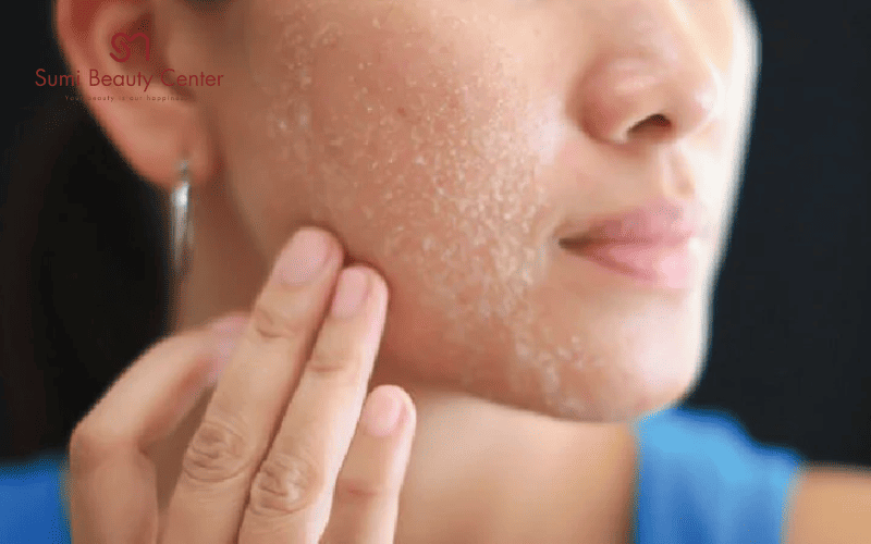 Da mặt bị mốc vào mùa đông