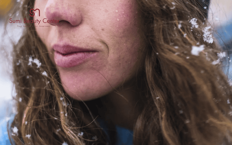 Da mặt bị nẻ vào mùa đông