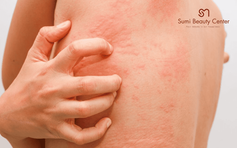 Dấu hiệu nhận biết dị ứng thời tiết lạnh