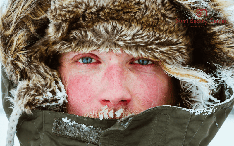 Dị ứng thời tiết lạnh ngứa, nổi mẩn đỏ