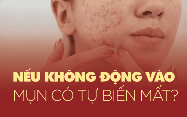 Không nặn mụn có tự hết không