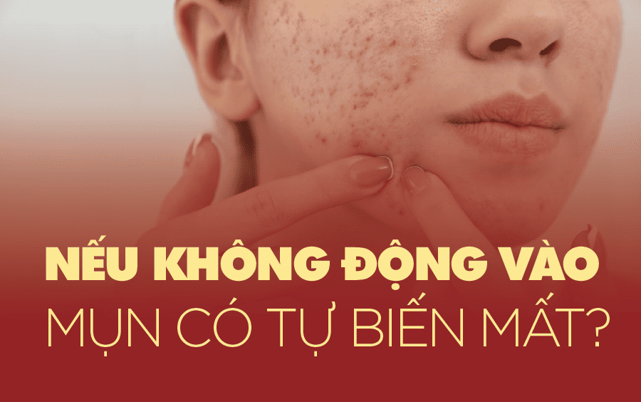 Không nặn mụn có tự hết không
