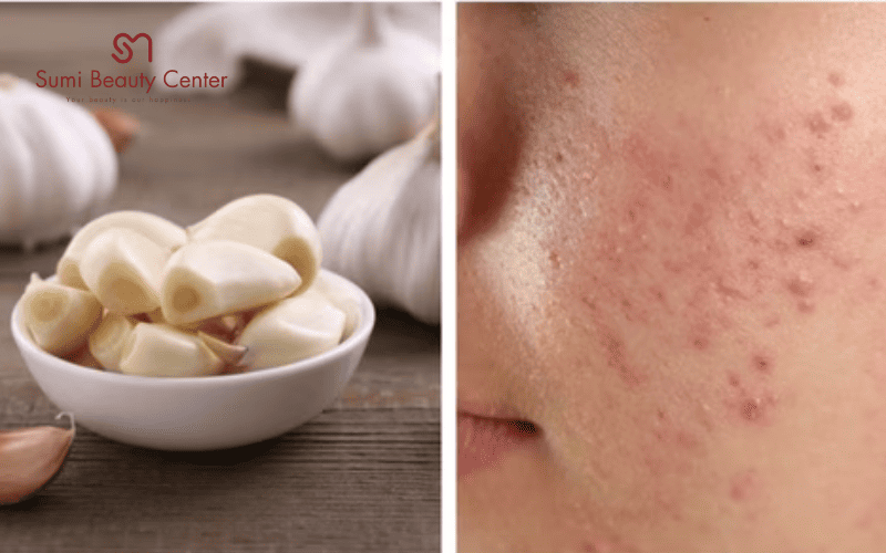 Lưu ý khi xông mặt bằng tỏi