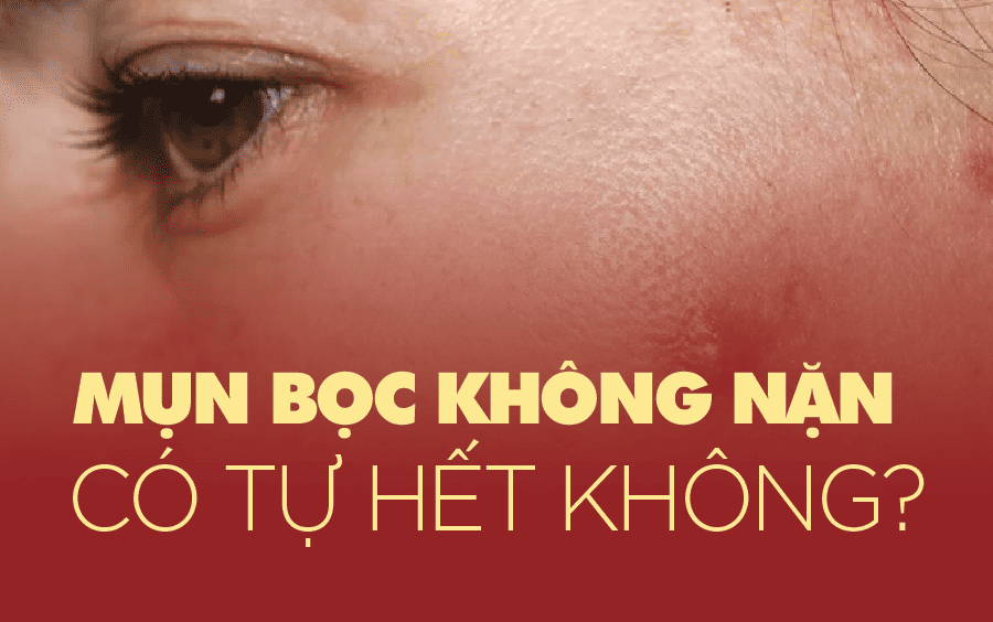 mụn bọc có tự xẹp không