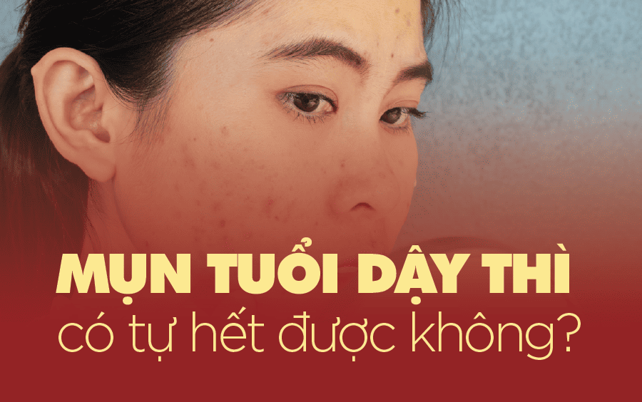 Mụn tuổi dậy thì có tự hết không?