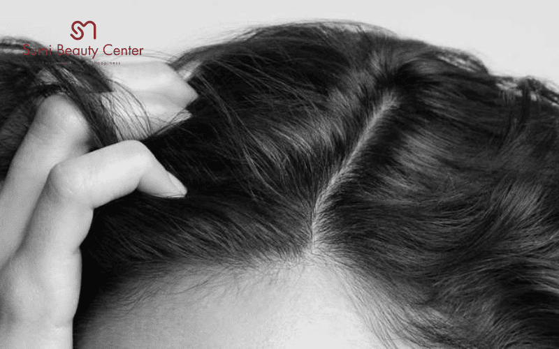 Người có da đầu nhạy cảm, dễ gàu