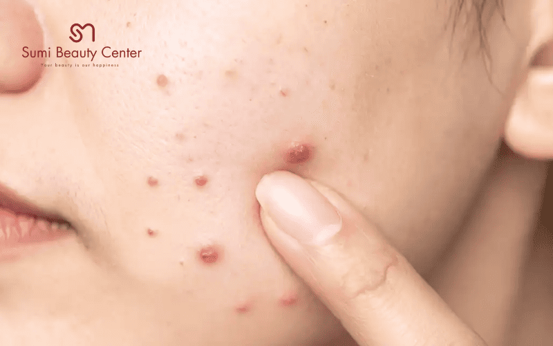 Tại sao mụn bọc bị chai cứng?