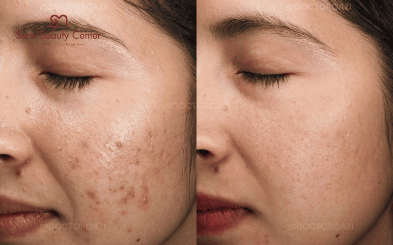 Xông mặt bằng lá tía tô trị mụn 