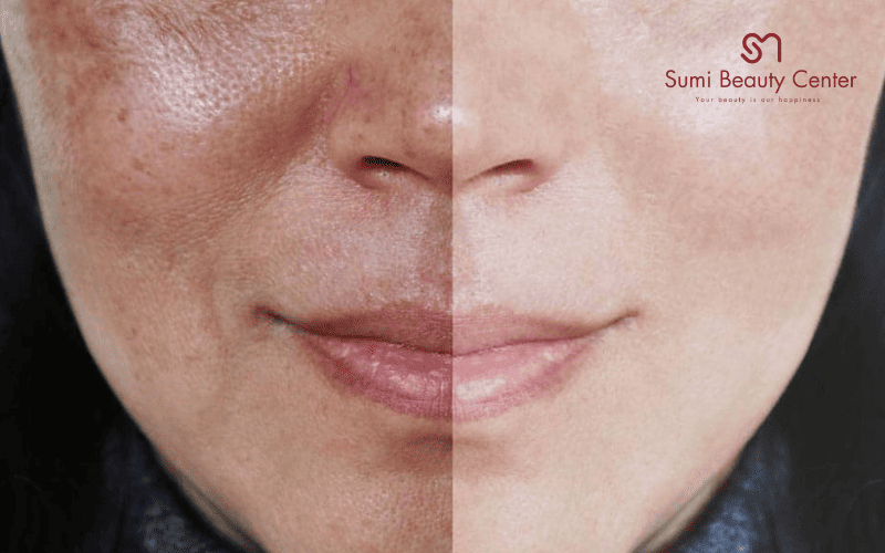 Xông mặt bằng lá tía tô trị nám